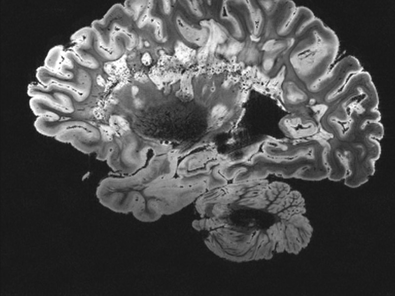 Neurochirurgie — IRM cérébrale